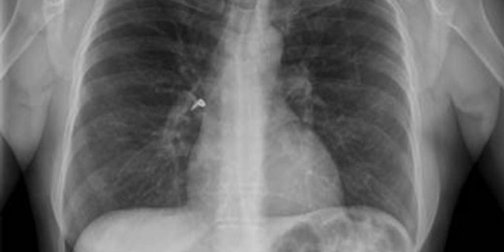 Woman Accidentally Gets Earring Stuck In Lung After Using Inhaler Fox News