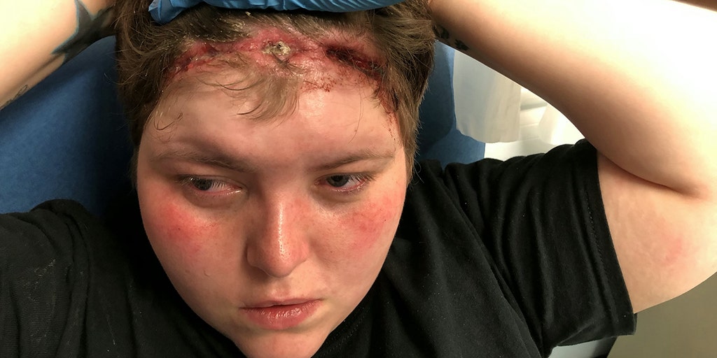 Woman Left With 6 Inch Scalp Gash From Too Tight Weave Fox News