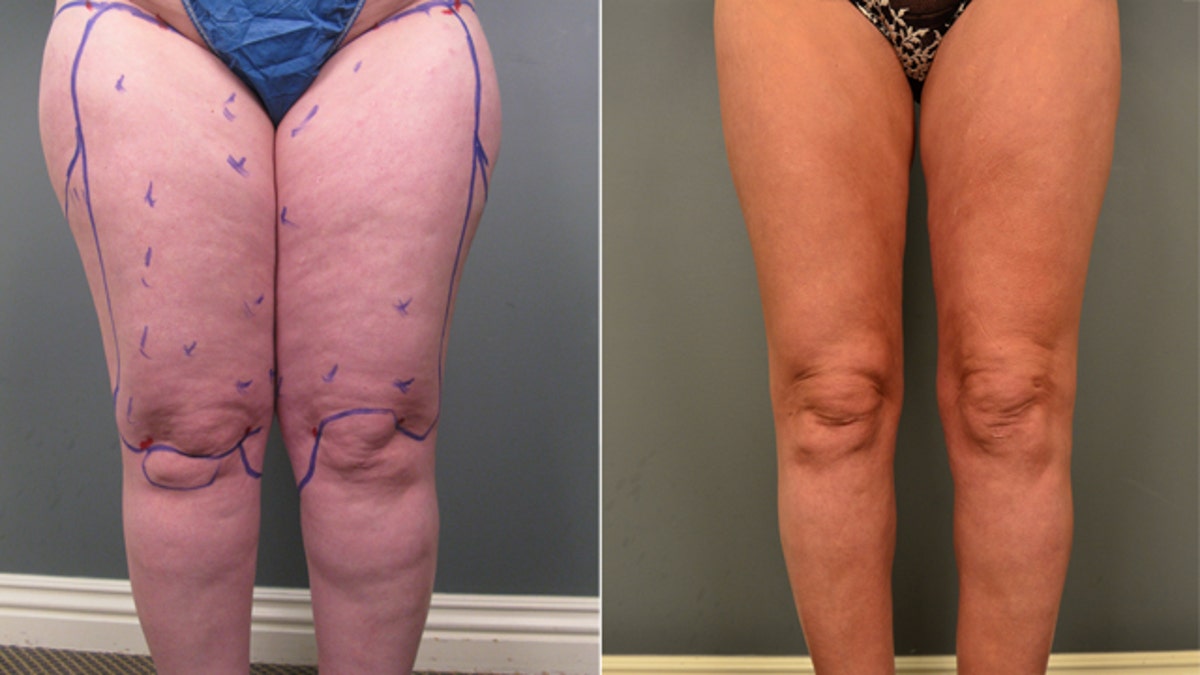 Skinny with large legs? Look into it, by Lipedema Journal