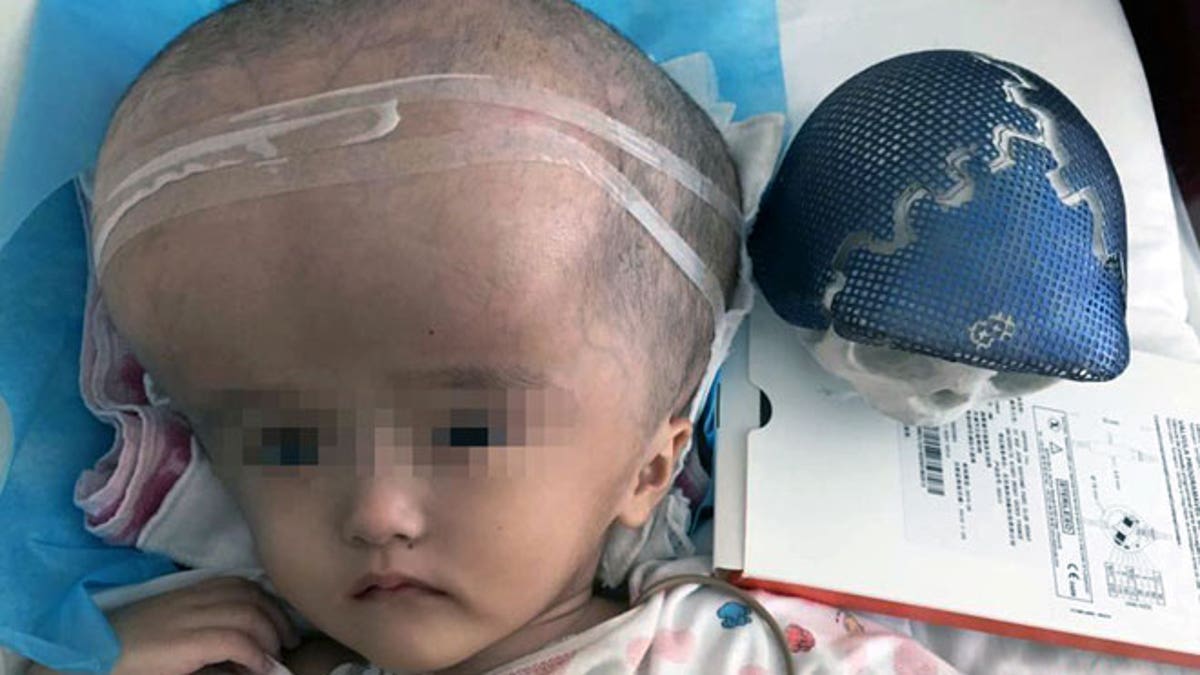 Toddler With Massive Head Saved By Ground Breaking Surger