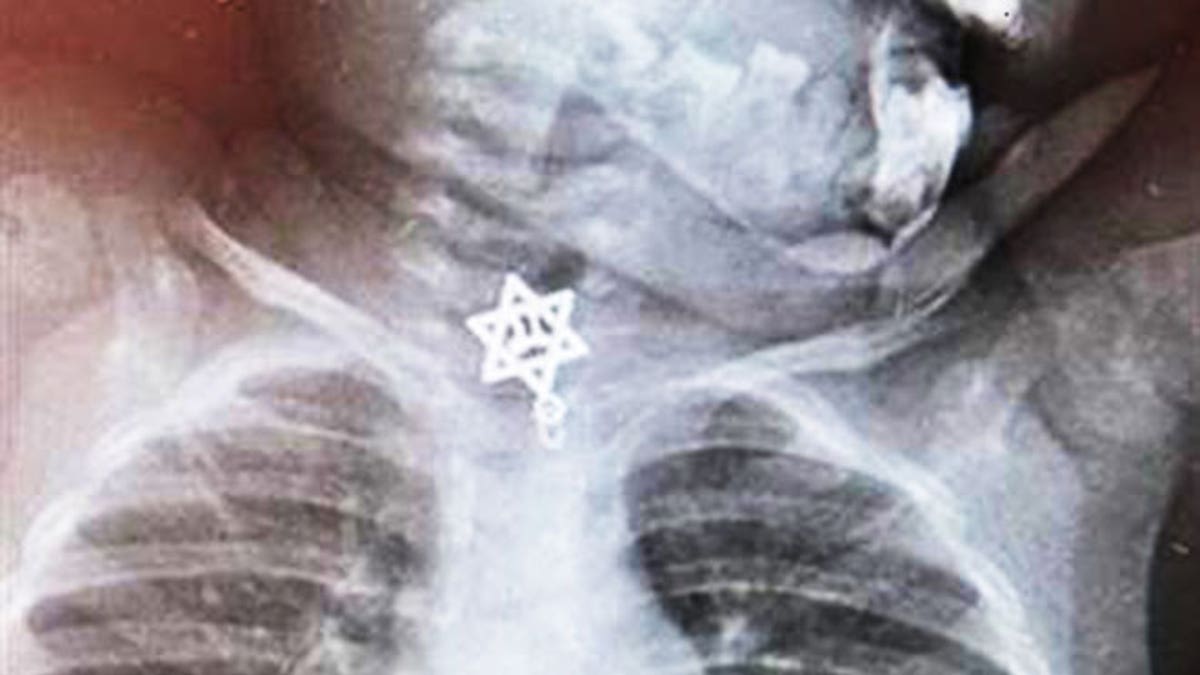 Doctors remove Star of David From Tots Throat