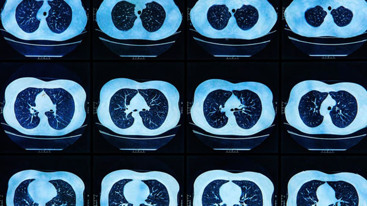 MRI scan of the human Lungs