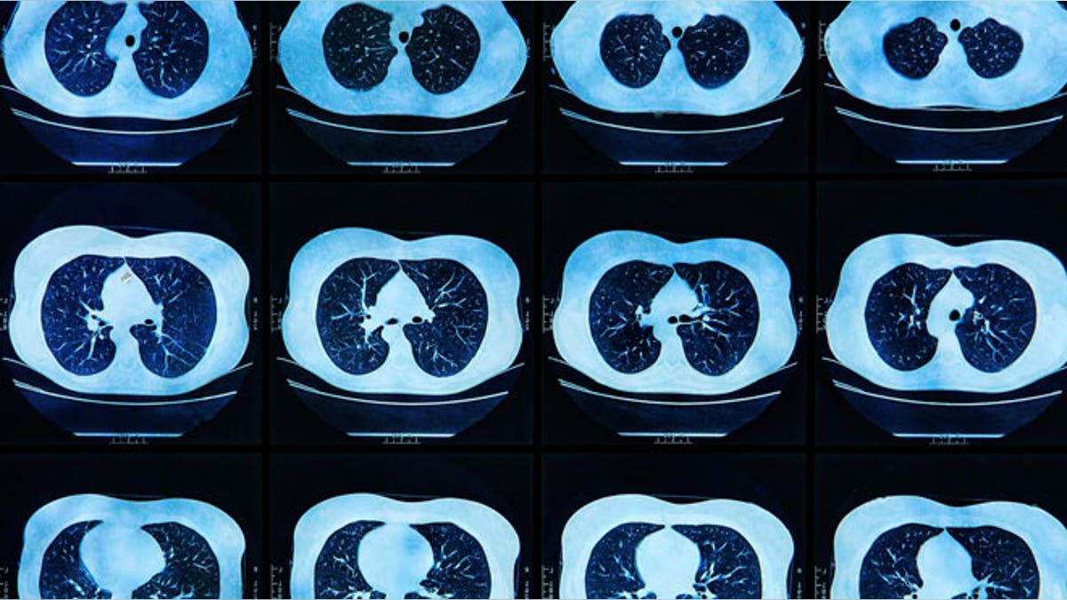 MRI scan of the human Lungs