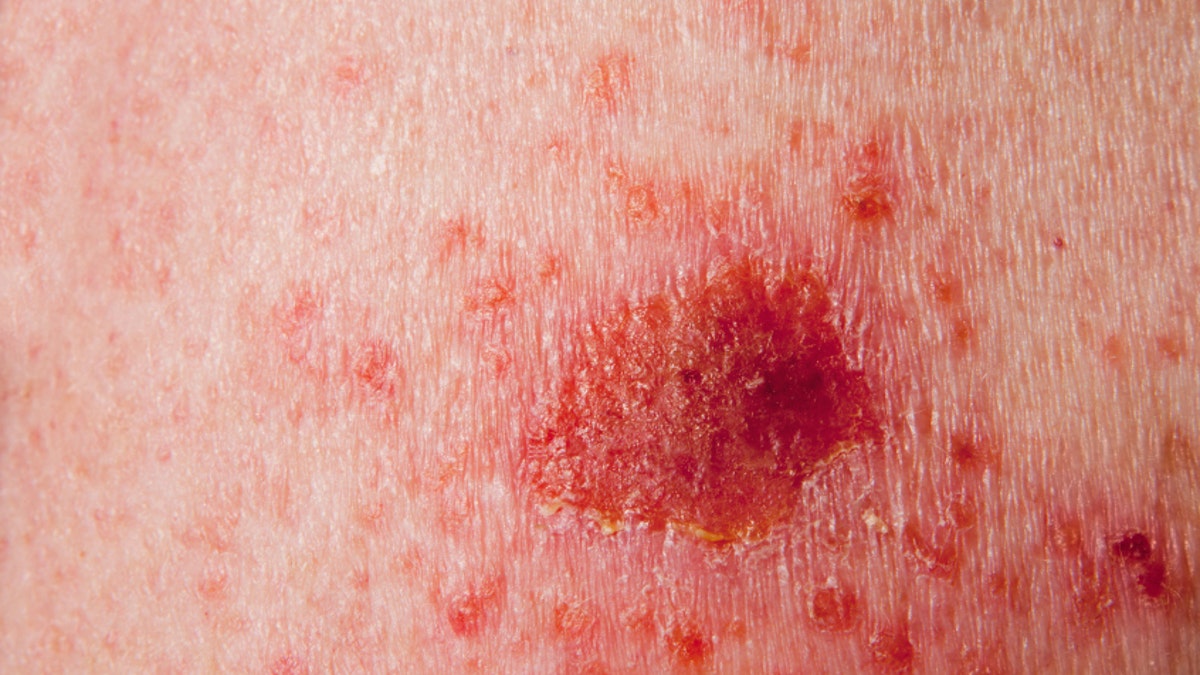 7989733d-Basal Cell Carcinoma