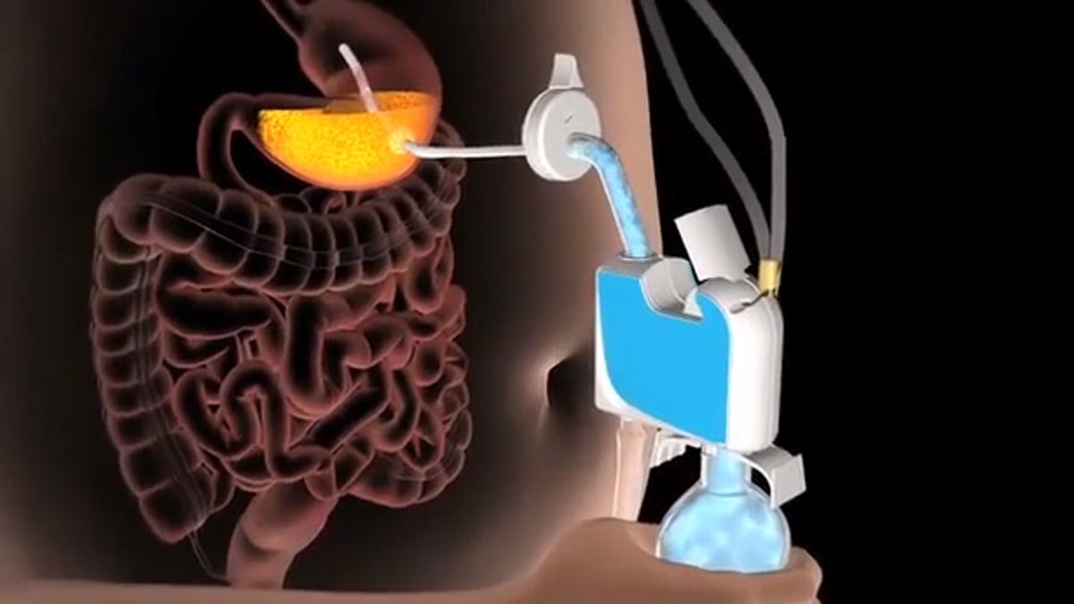 Extreme weight loss New personal stomach pump sucks food straight