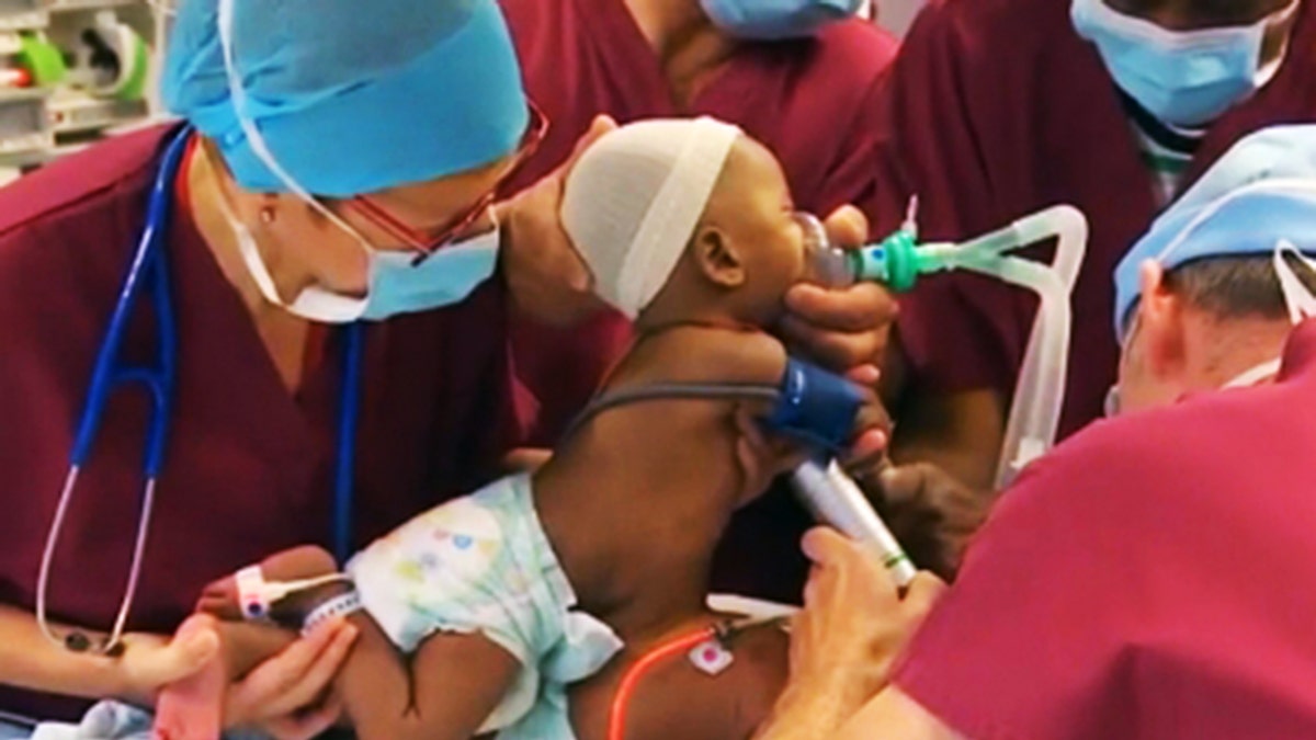Surgeons Separate Conjoined Twins After 9 Hour Op