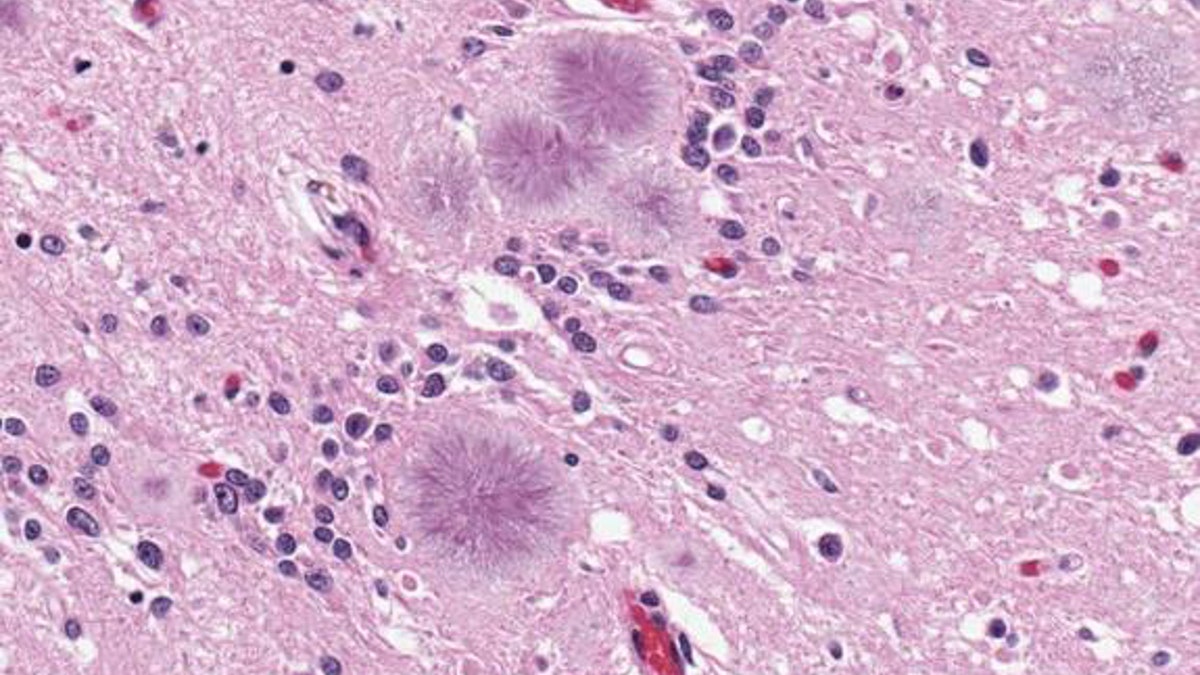 Penyakit otak mematikan pada pria Amerika mungkin berasal dari daging sapi Inggris