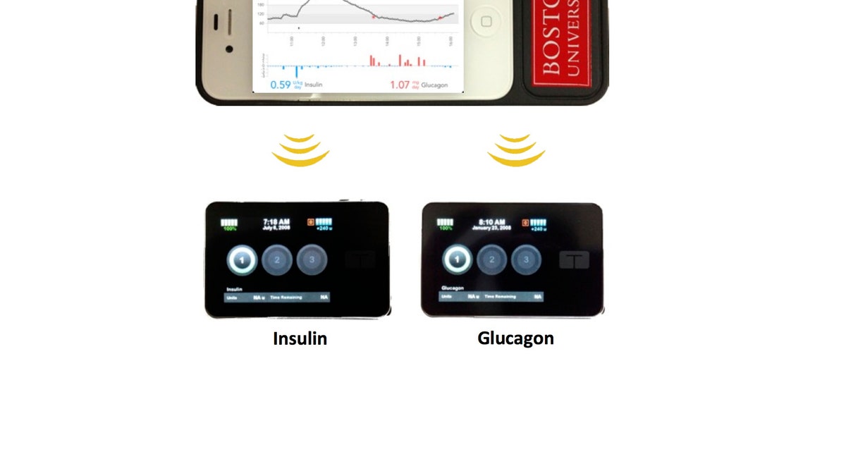 Diabetes Bionic Pancreas