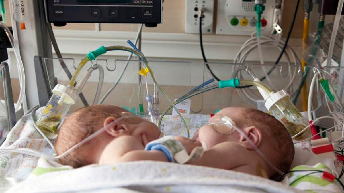 Dallas Conjoined Boys