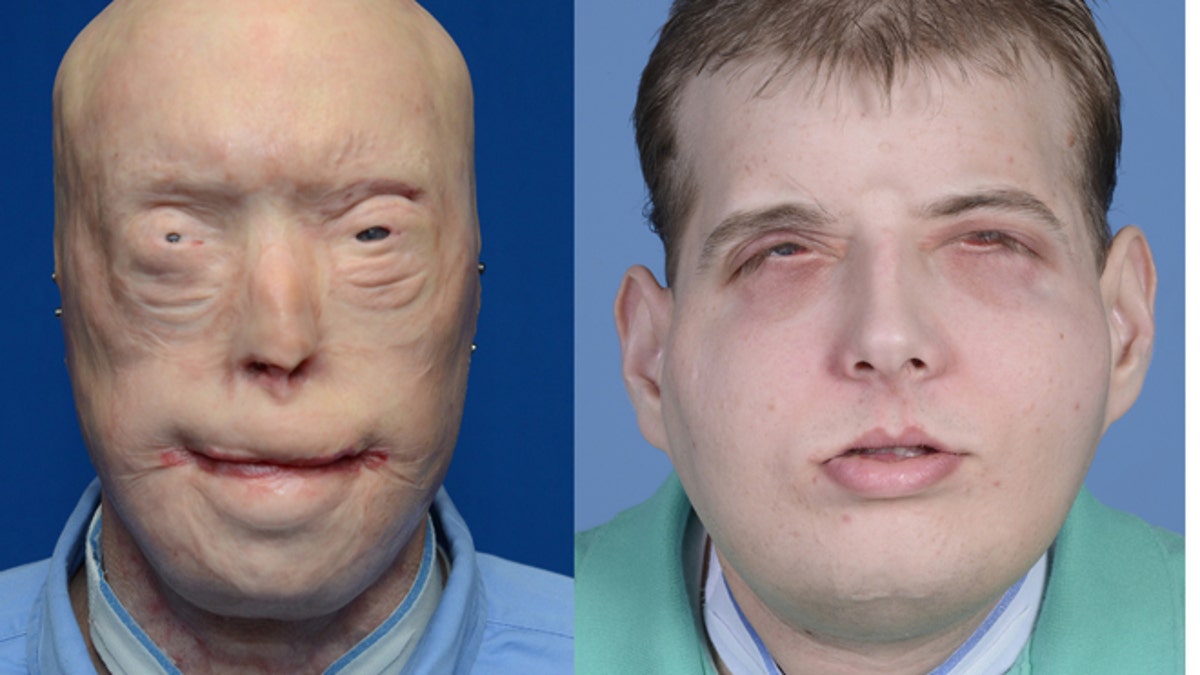 89c288ad-Face Transplant