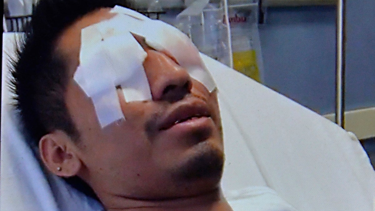 July 11, 2018 - New York, New York, United States: Gonzalo Luis-Morales while in the hospital. The former bar back at the Frying Pan bar/restaurant, lost the use of his left eye after a Corona bottle exploded in his face while at work as he placed it in an ice bucket for customers, permanently rendering the eye useless. Luis-Morales is suing Corona brewer Constellation Brands Inc., bottle manufacturer Owens-Illinois Inc. and distributor Manhattan Beer for negligence. (Matthew McDermott/Polaris) /// 

