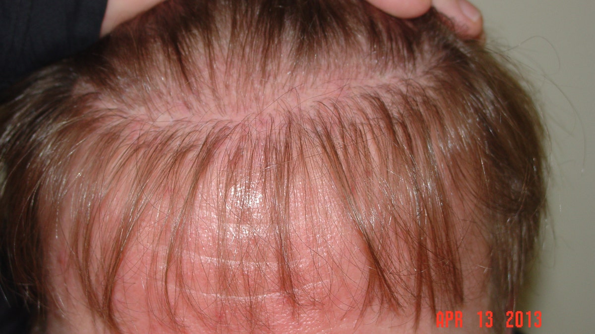 Experts burst myths about hair transplantation