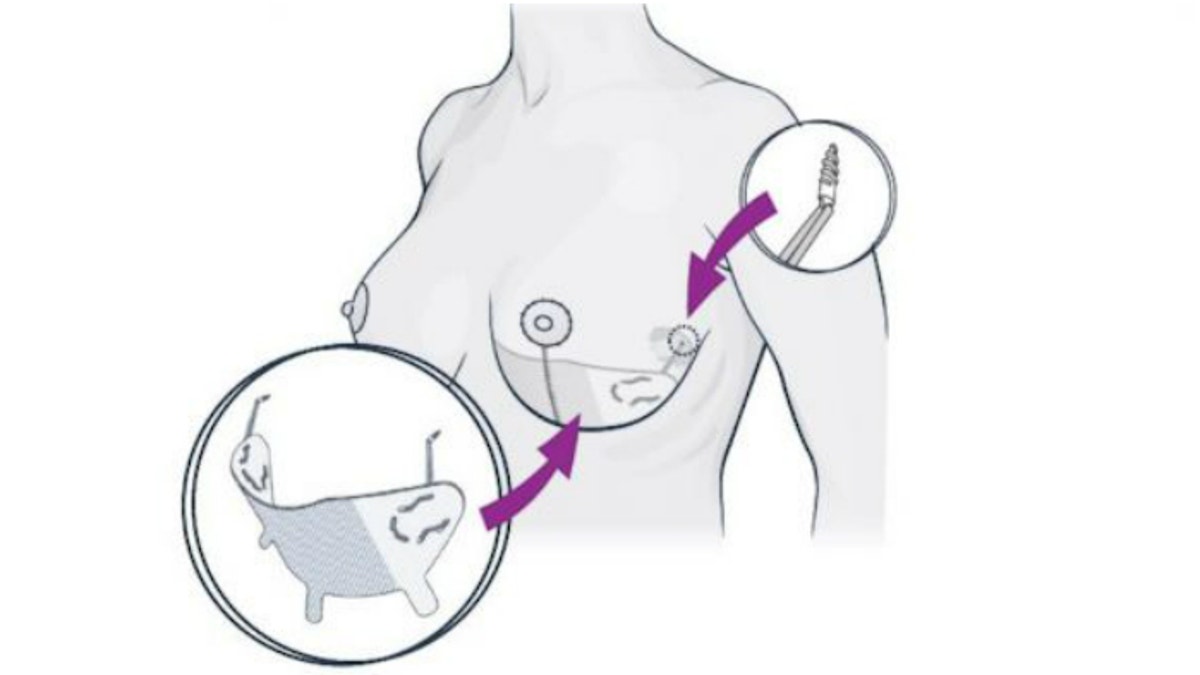 Controversial 'internal bra' procedure promises a longer lasting breast  lift