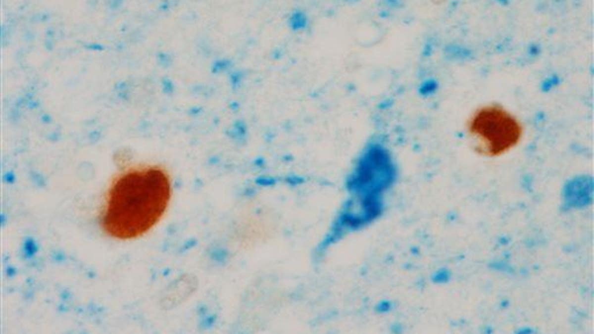 Alzheimers New Biomarker