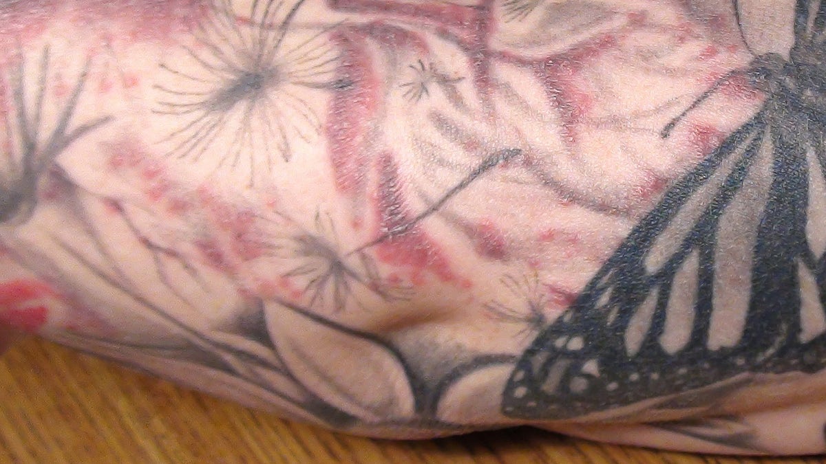 Tattoo Infection