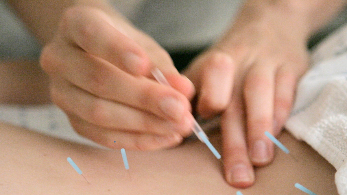 Back Pain Acupuncture