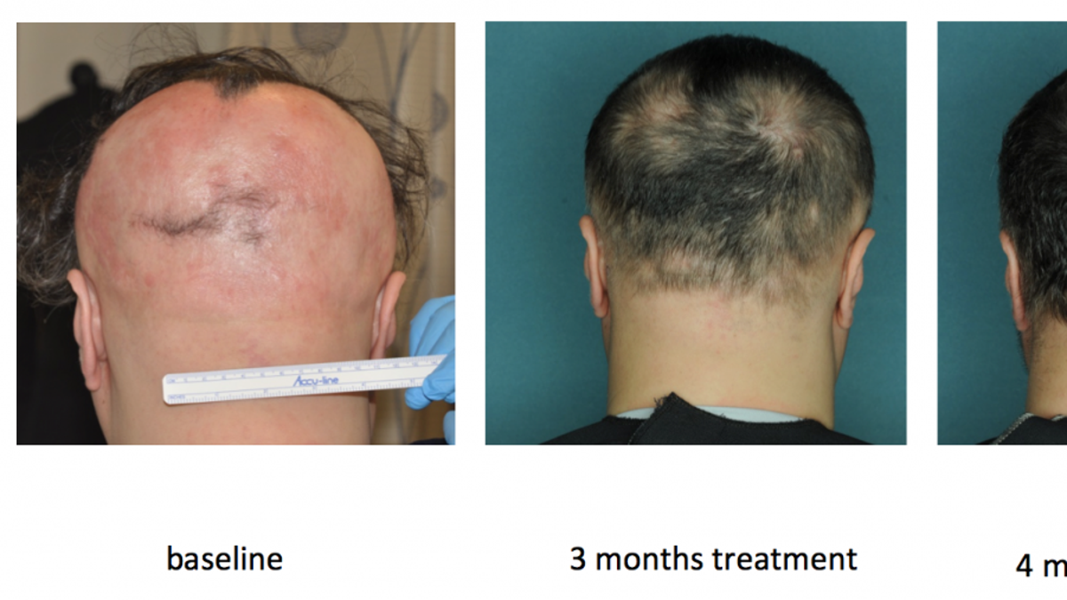 alopecia treatment columbia u