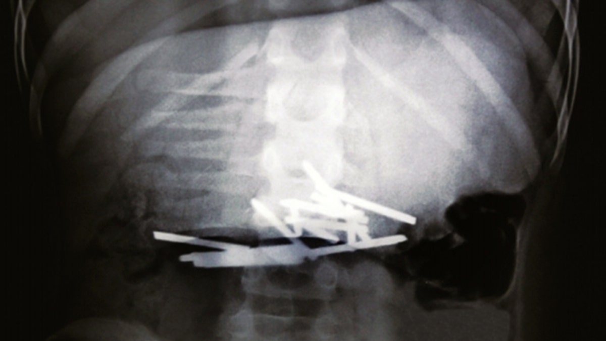 Doctors remove 600 nails from man's stomach