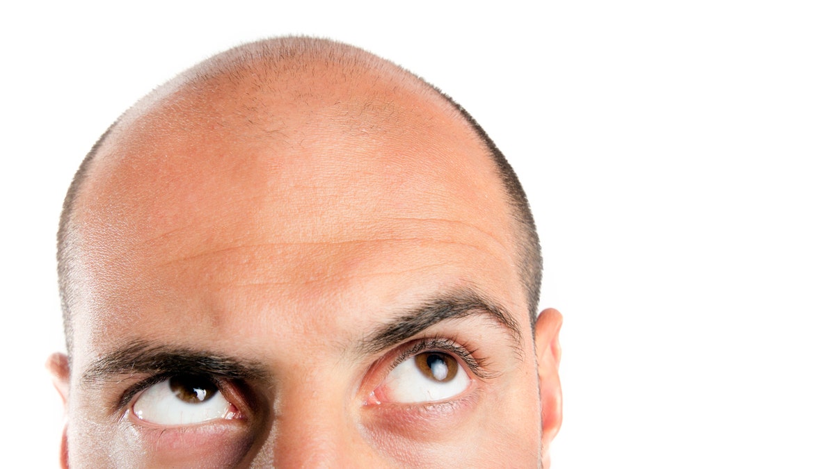 bald man baldness istock medium