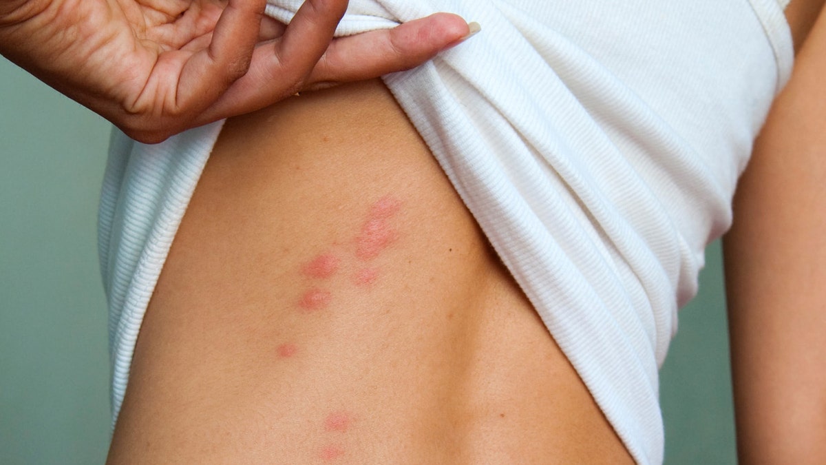 bed bug bites getty