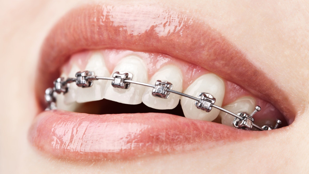 teeth with braces