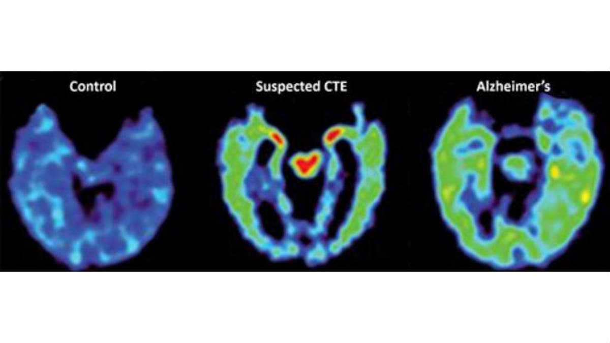 This combination of PET scans provided by UCLA on April 2, 2015 shows, from left, a normal brain scan, a suspected Chronic Traumatic Encephalopathy (CTE) subject, and a subject with Alzheimer's disease. (AP Photo/PNAS/David Geffen School of Medicine at UCLA)

