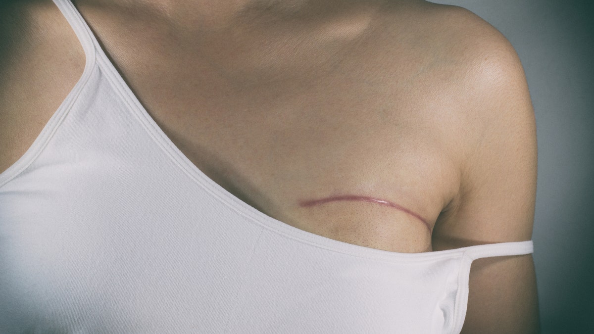breast cancer surgery scar istock