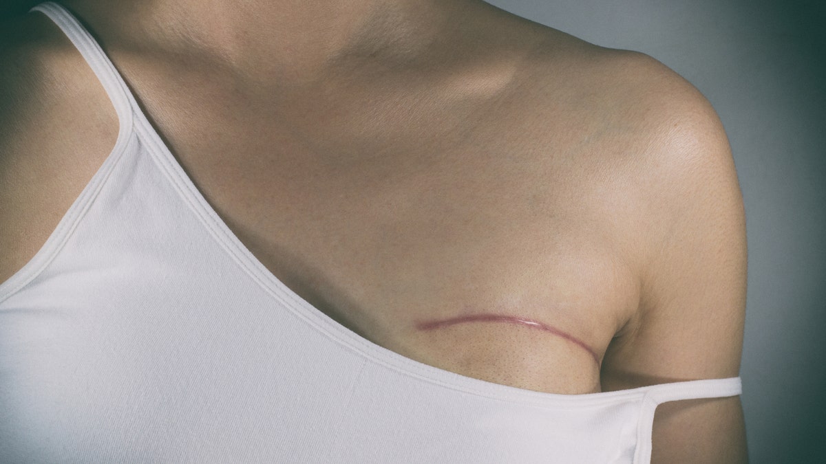 breast cancer surgery scar istock