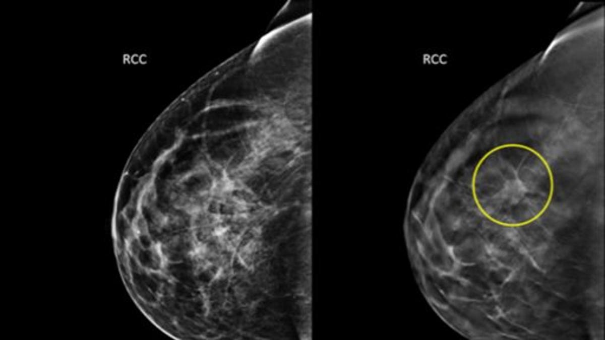 3D Mammograms
