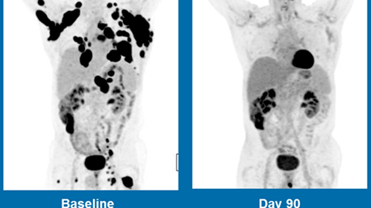 cancer_gene_therapy_661