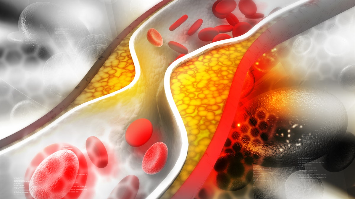 cholesterol plaque in artery istock large