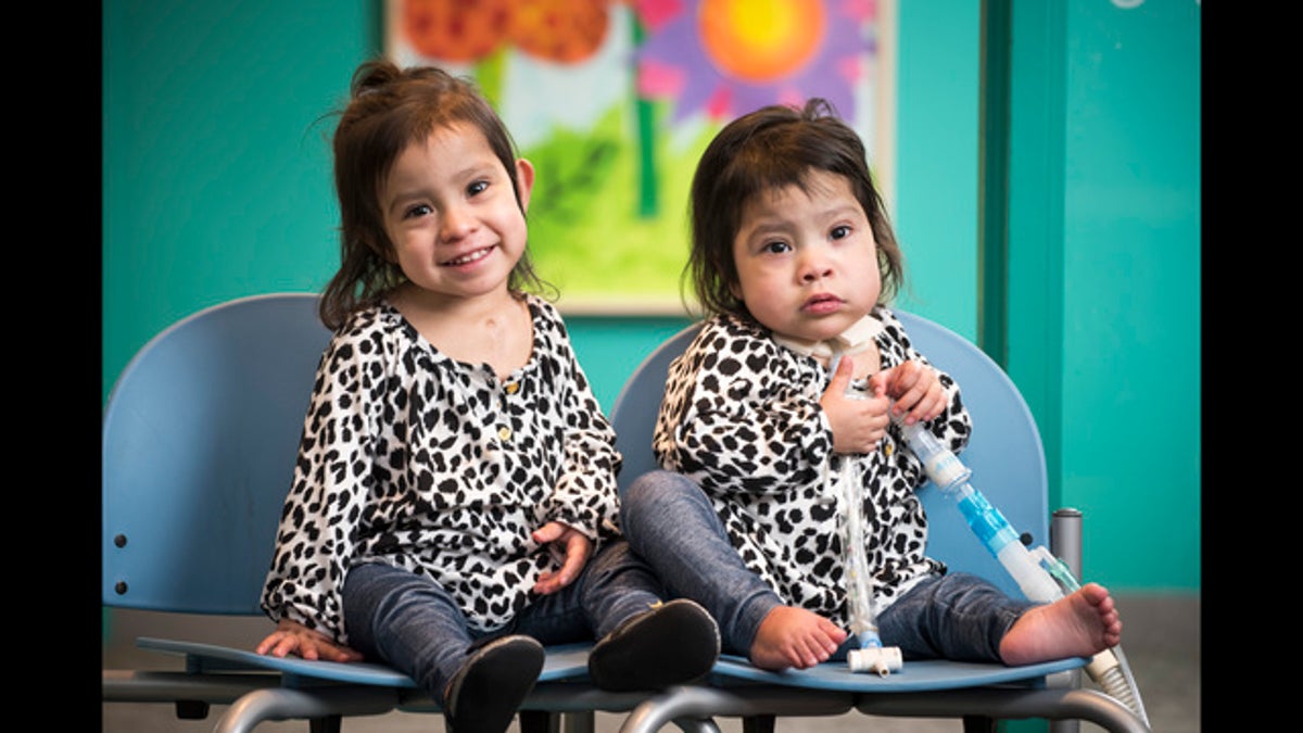 Conjoined twins are successfully separated after being locked in embrace