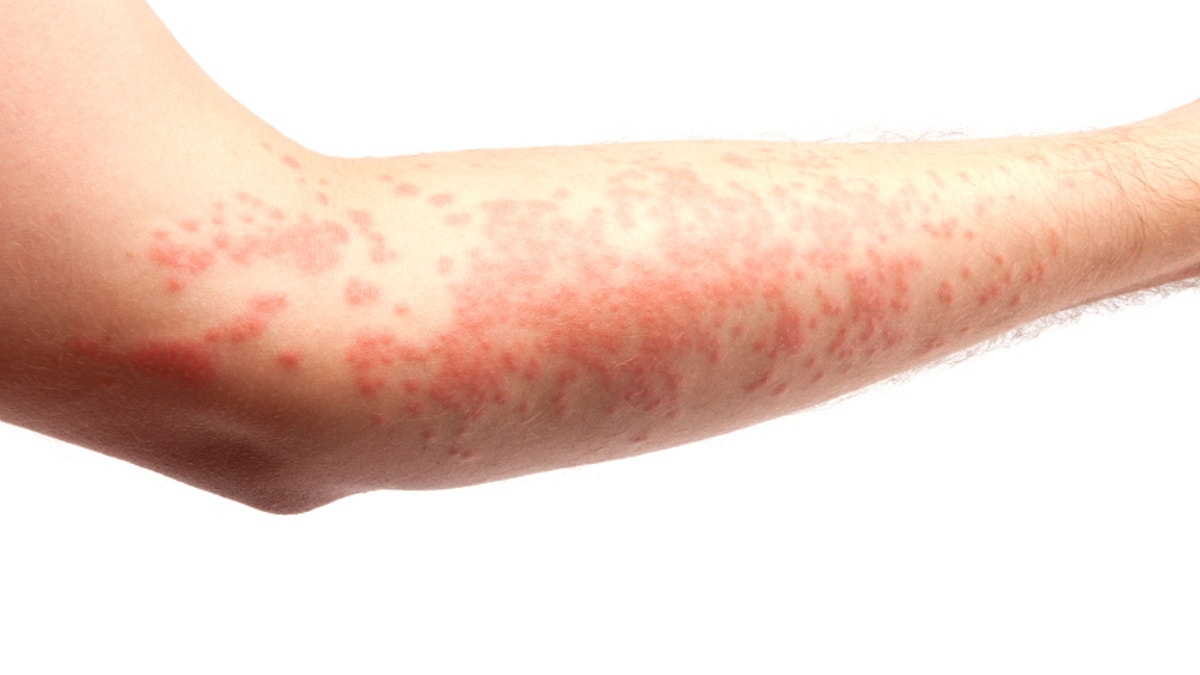 d6083b95-skin allergy