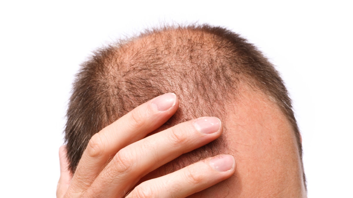 I am 22 years old and suffering from male pattern baldness stage 2 Shall  I go for PRP and then in the future if it increases can I go for a  transplant  Quora