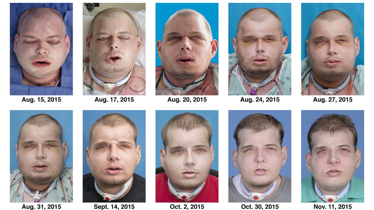 hardison_facial_transplant_timeline_ap