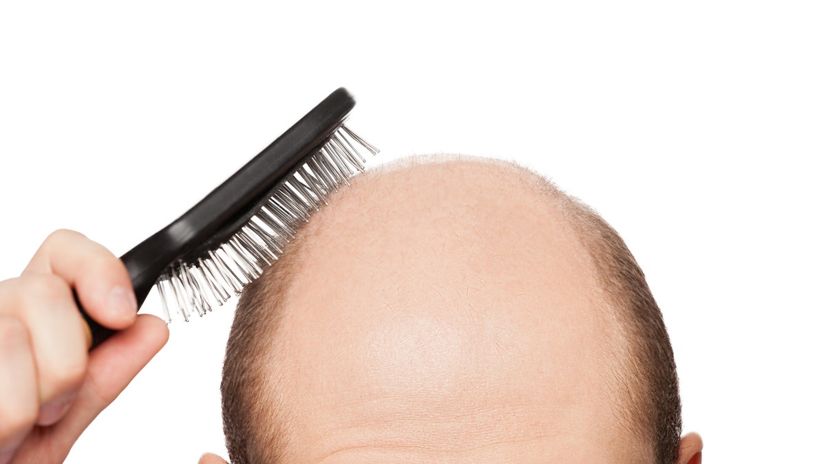 going bald baldness istock