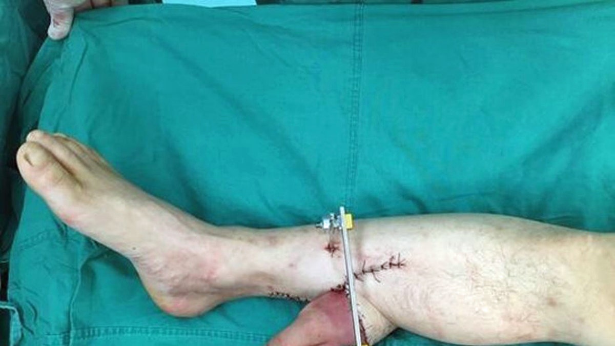 Surgeons Save Hand By Grafting It To Leg