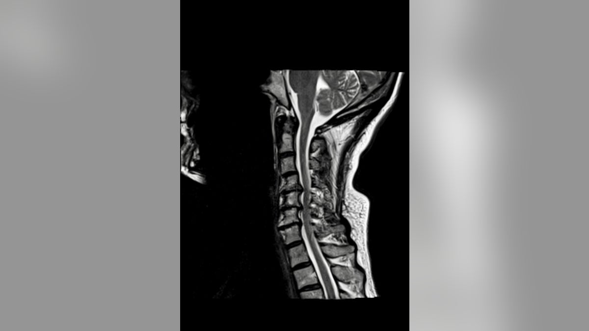 The author's cervical spine before surgery showing spinal cord compression in three areas.
