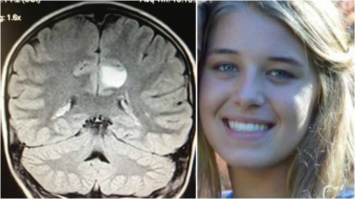 holland carlton brain tumor CHOA