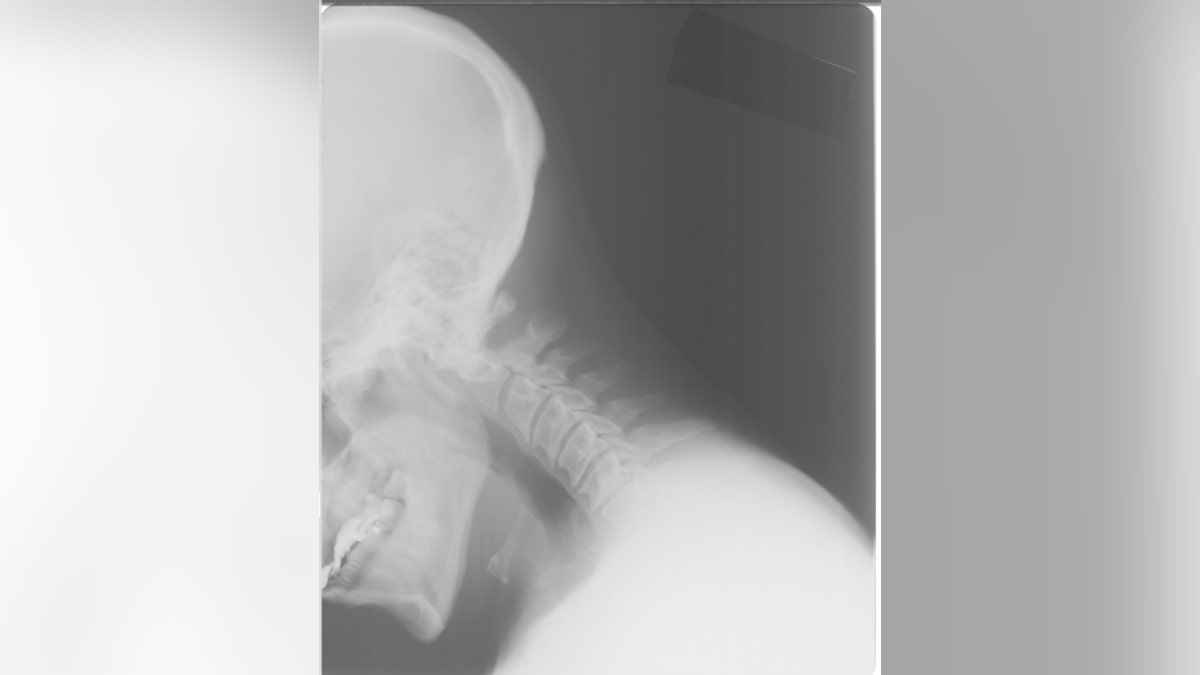 internal decapitation x-ray