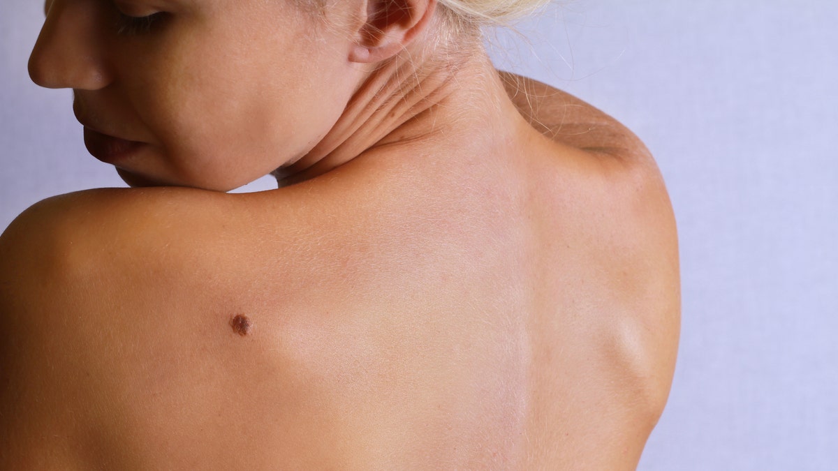 birthmark_skincheck_istock