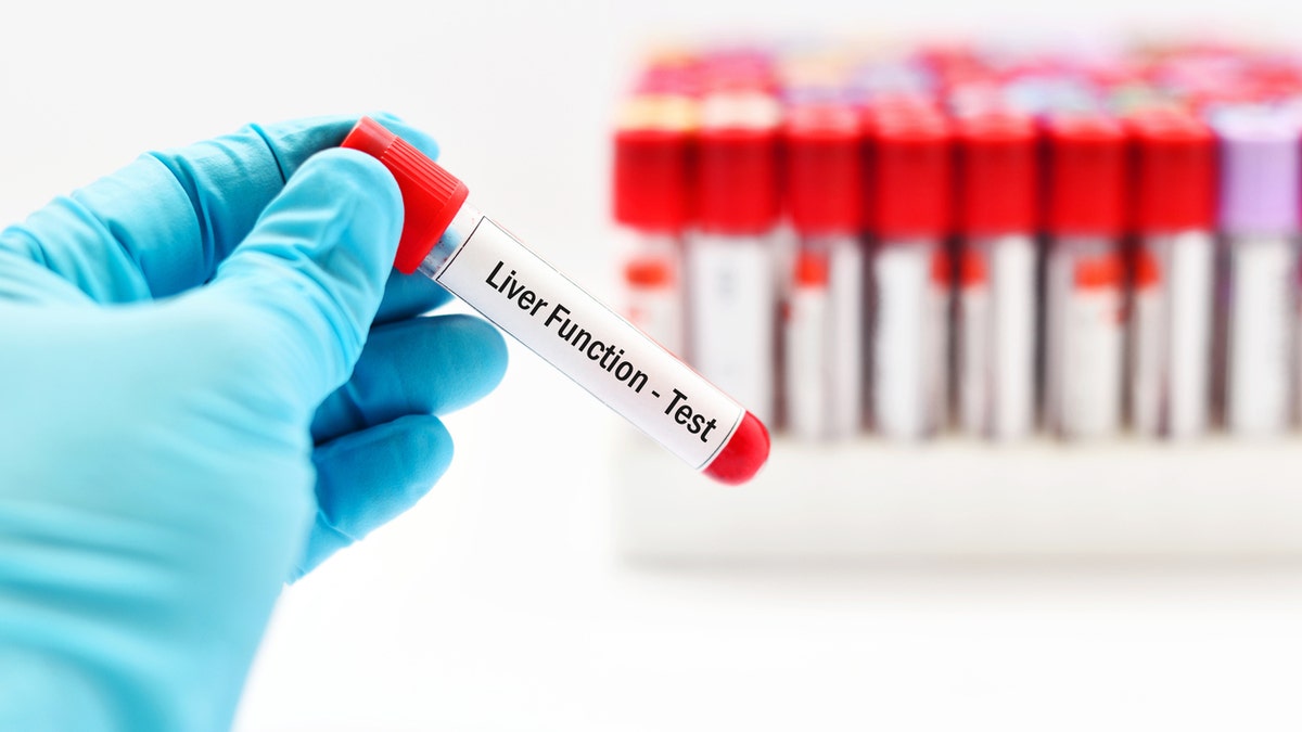 Blood sample for liver function test