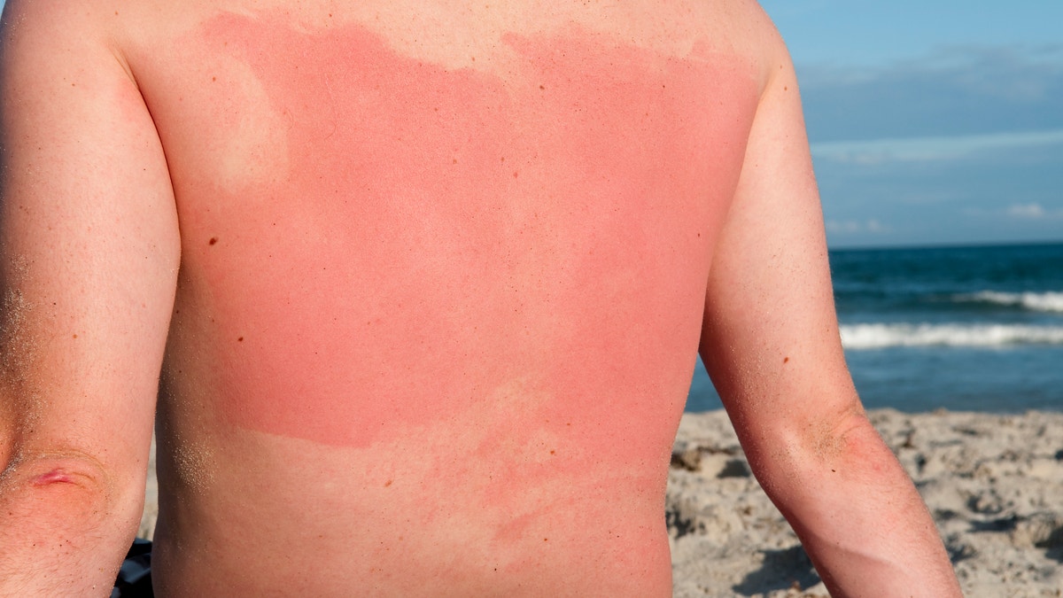 A man with sunburn on the beach