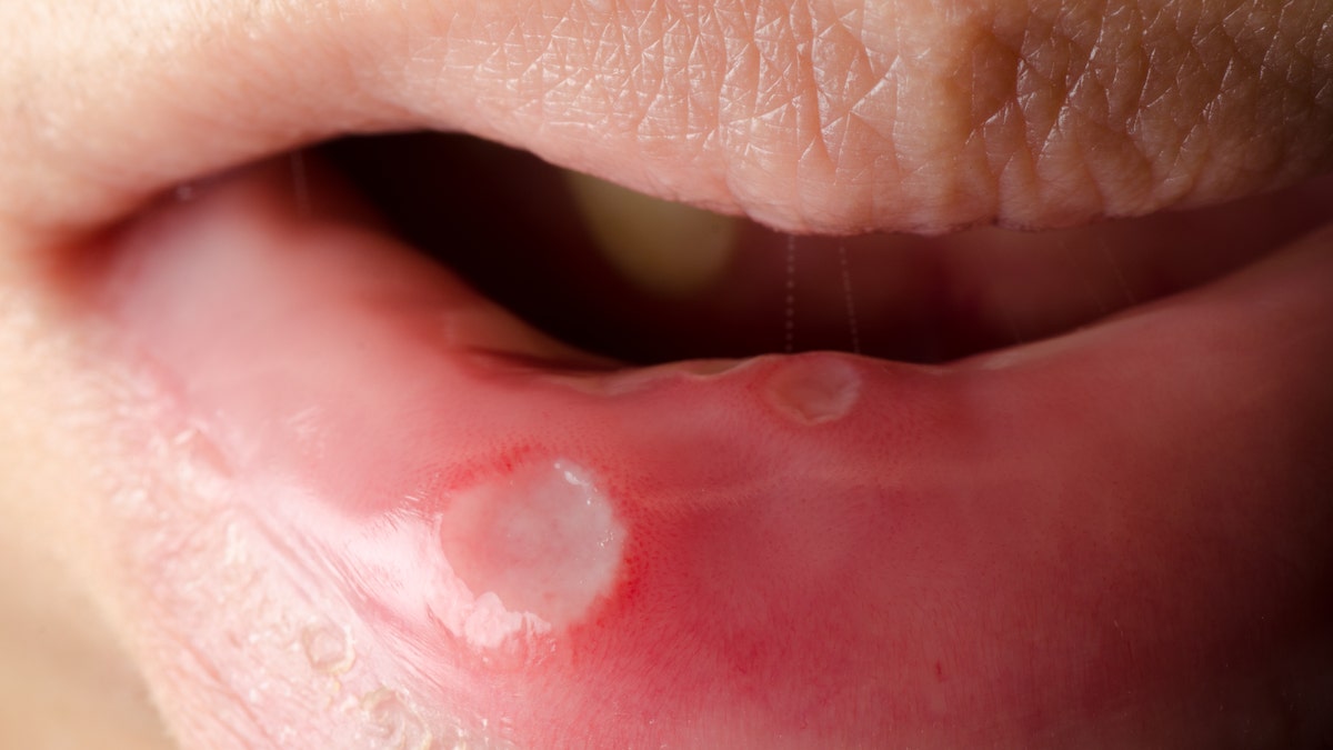 canker_sore_istock