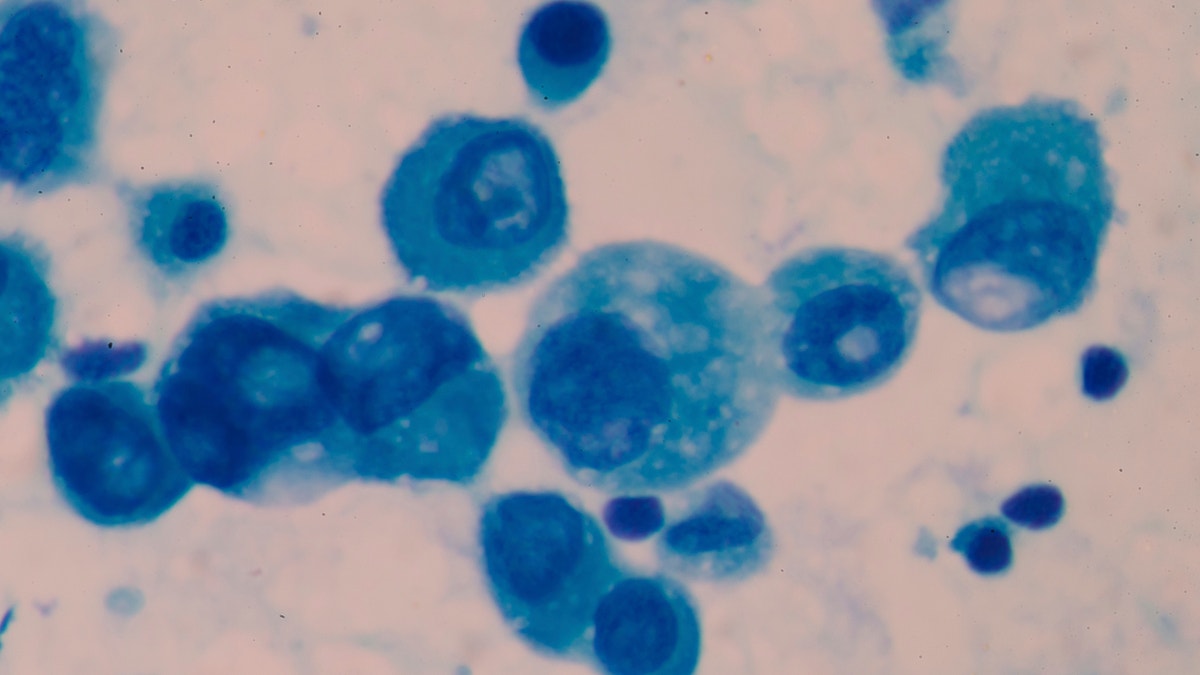 cancer_cells_slide_istock