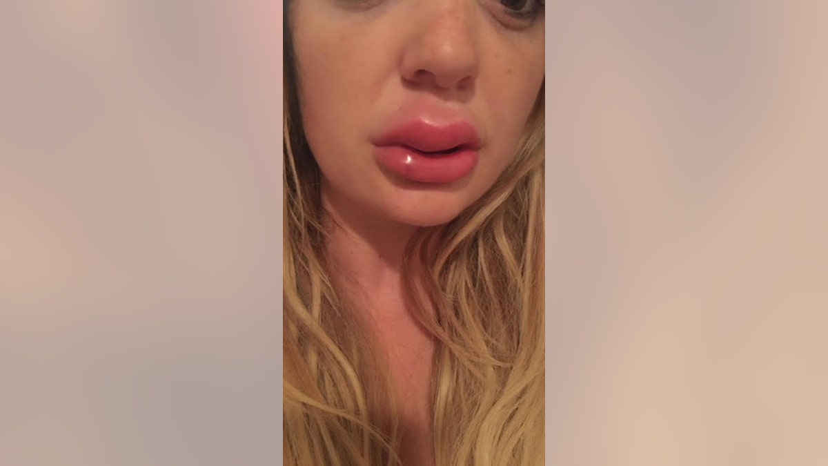 A mum is warning others about having lip fillers after she was left with infected, swollen lips following an injection.Jessica Bennett from Sandiacre, Nottinghamshire, says she wouldn't go as far as advising women not to have the treatment done - but would tell them to shop around to make sure they are getting it done properly.The 24-year-old said her own problems had occurred when she had received a one millilitre injection of filler relatively soon after her previous treatment.