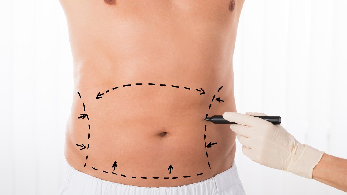 liposuction men plastic surgery istock medium