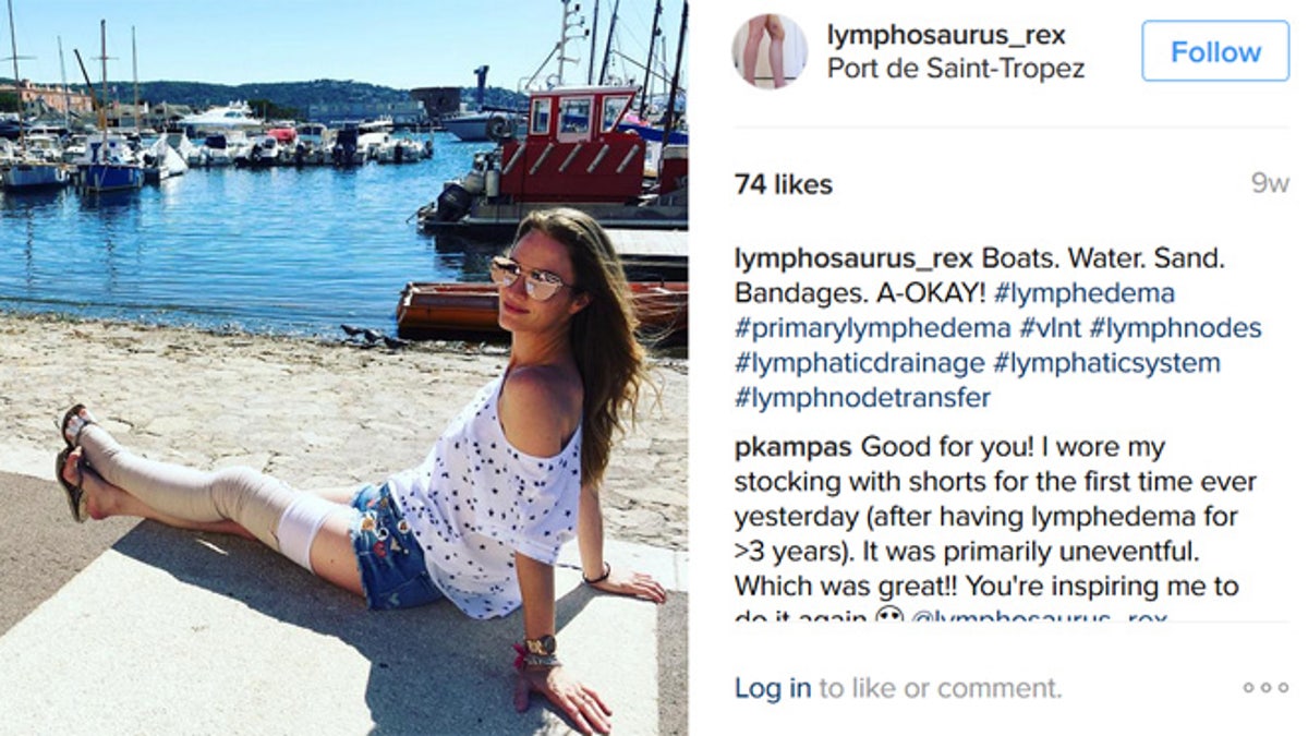 lymphedema_661