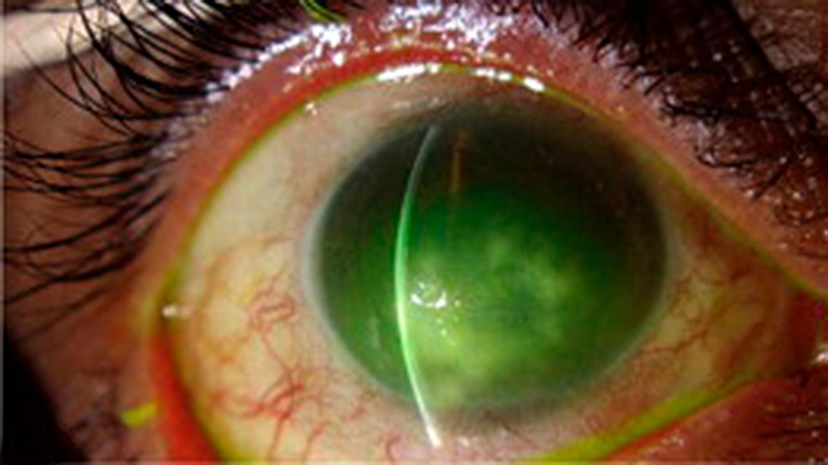 microsporidial_keratitis_1