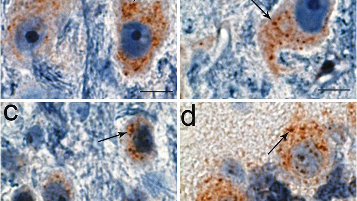 parkinsons genetic mutation Northwestern